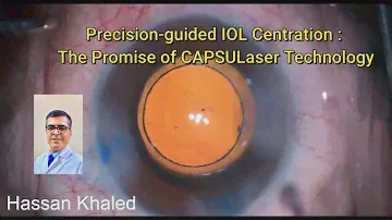 Precision guided IOL Centration : The Promise of CAPSULaser Technology